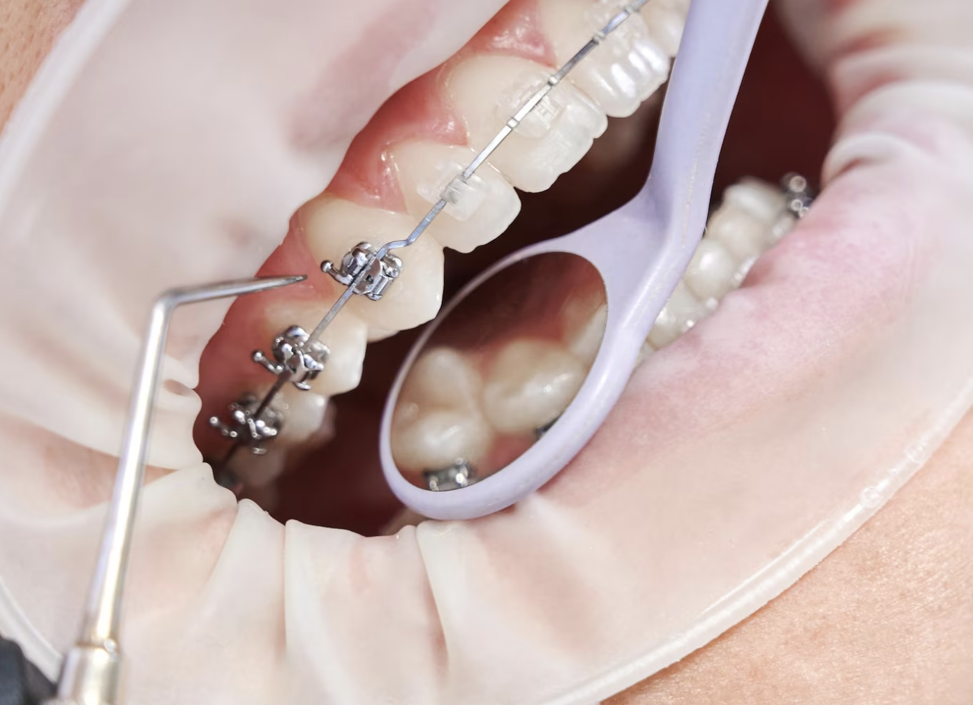 Is Early Orthodontic Treatment Right for Your Child?